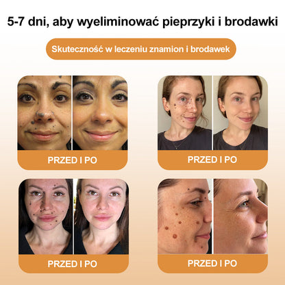 🌿🌿🌿[✨Oficjalny sklep markowy✨] krem BSWELL™ PSZCZOŁA JAD do usuwania brodawek i pieprzyków(👨‍⚕️PTD AJÁNLJA)