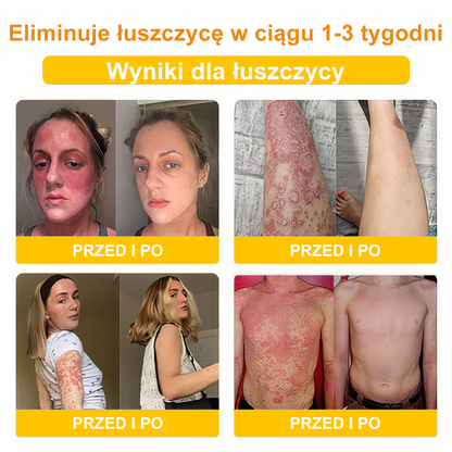 🌼💁‍♀️Velisse™ Krem Antybakteryjny z Jadem Pszczelim na Łuszczycę – Leczy Wiele Schorzeń Skóry (Zalecany przez ADD)