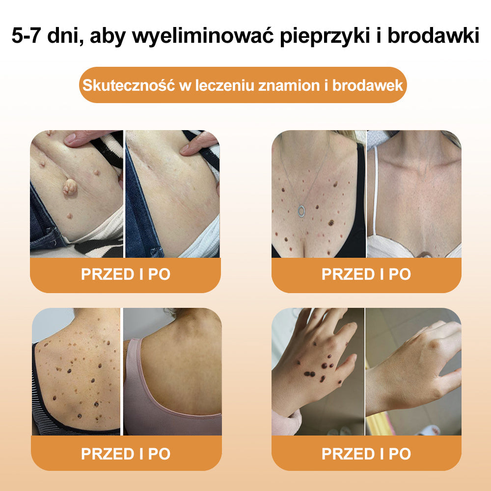 🌿🌿🌿[✨Oficjalny sklep markowy✨] krem BSWELL™ PSZCZOŁA JAD do usuwania brodawek i pieprzyków(👨‍⚕️PTD AJÁNLJA)